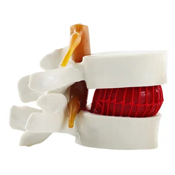 Model Omurga Lomber Herniasyon Disk İnsan Modelleri Anatomik Vertebra Anatomi Vertebral Öğretim Intervertebral Kayropraktik