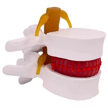 PVC Lomber Vertebral İnsan Lomber İntervertebral Disk Hernisi gösteri modeli Tıp Bilimi Öğretim Malzemeleri